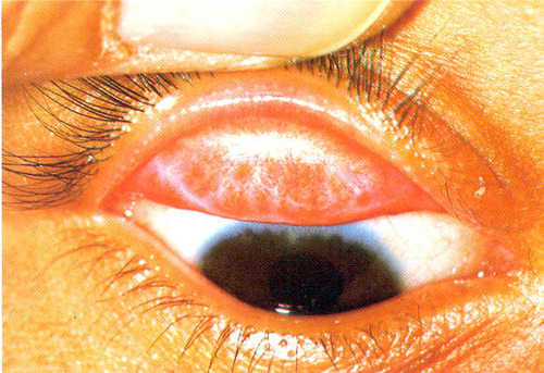 LE TRACHOME : une maladie pandémique trop méconnue…