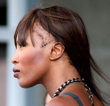 SOLUTIONS NATURELLES CONTRE L’ALOPECIE