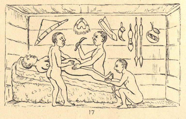 La chirurgie africaine traditionnelle : la césarienne